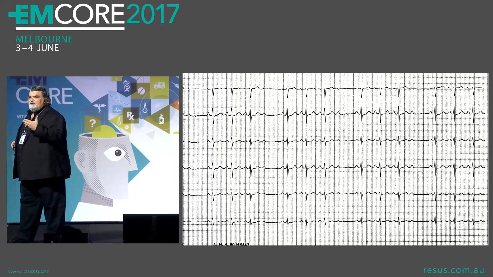 Rule the Arrhythmia Assoc Prof Peter Kas