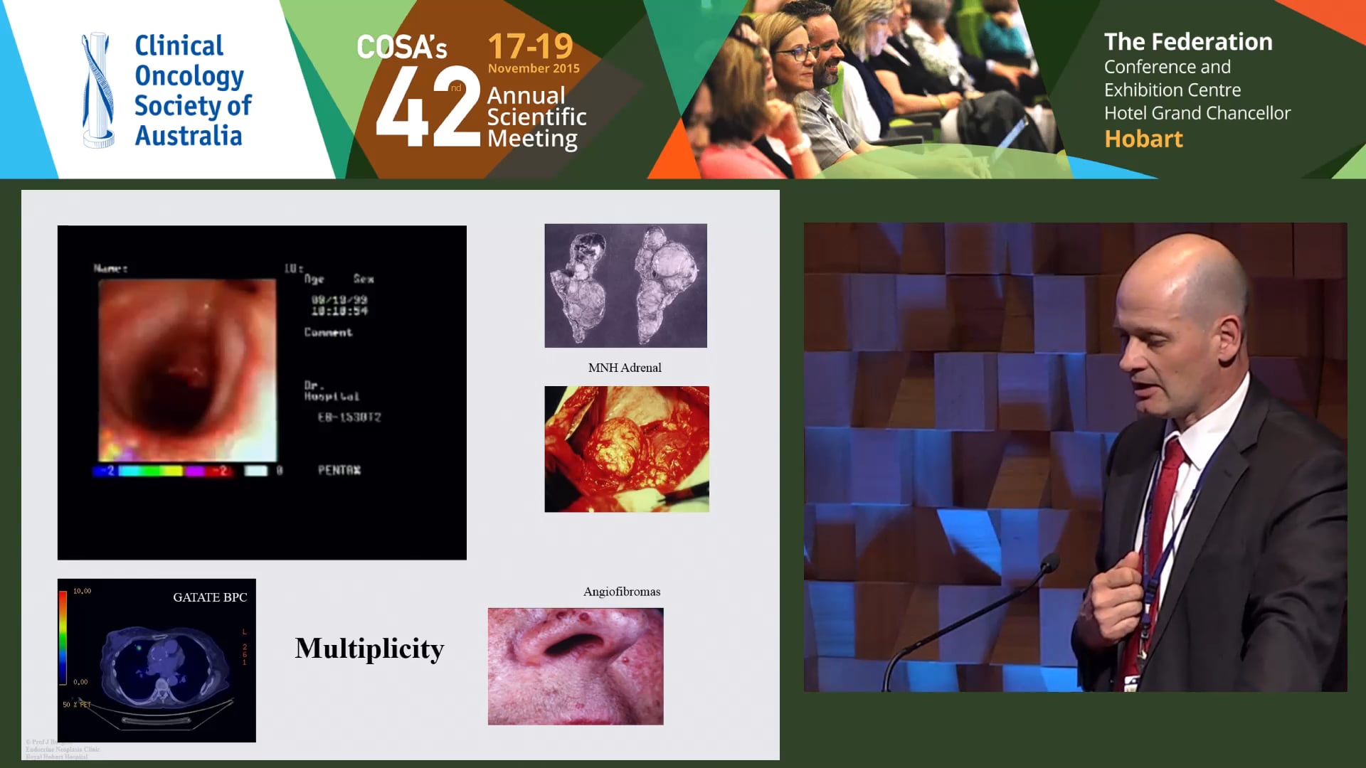 John Burgess Pancreatic neuroendocrine tumours in MEN 1 – basic science & clinical management