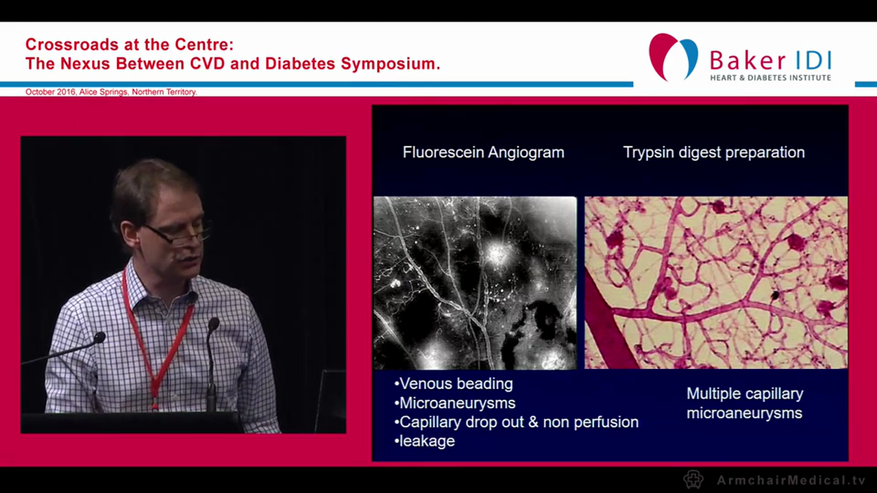 Diabetic Eye Problems Dr Tim Henderson