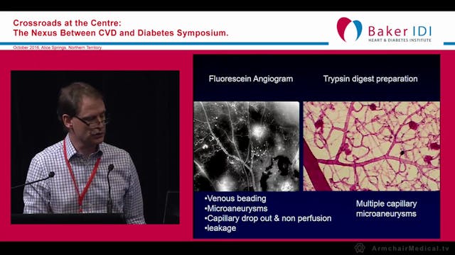 Diabetic Eye Problems Dr Tim Henderson