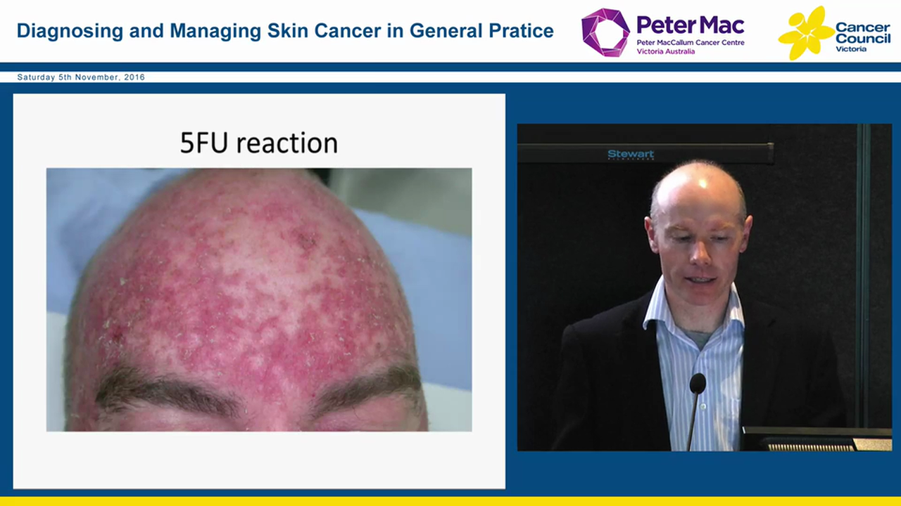 Solar keratoses Which treatments to use where Dr Edward Upjohn