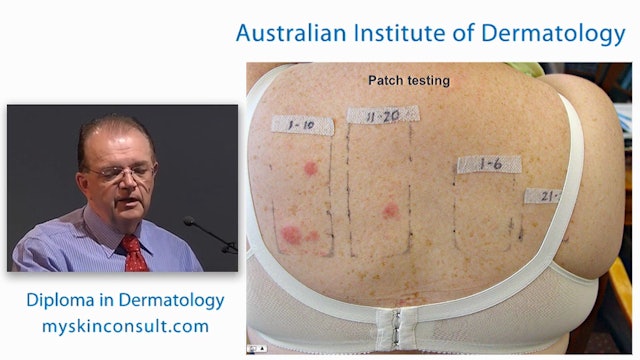 Eczema and Patch Testing Dr. Ian McColl John Flynn Private Hospital