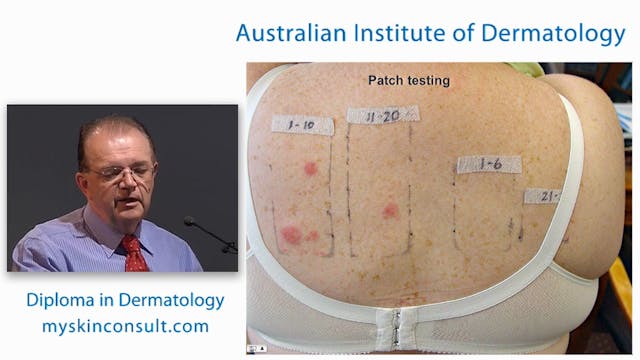 Eczema and Patch Testing Dr. Ian McCo...
