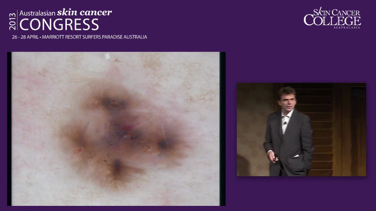 Last Man Standing Dermoscopy Challenge Prof Harald Kittler