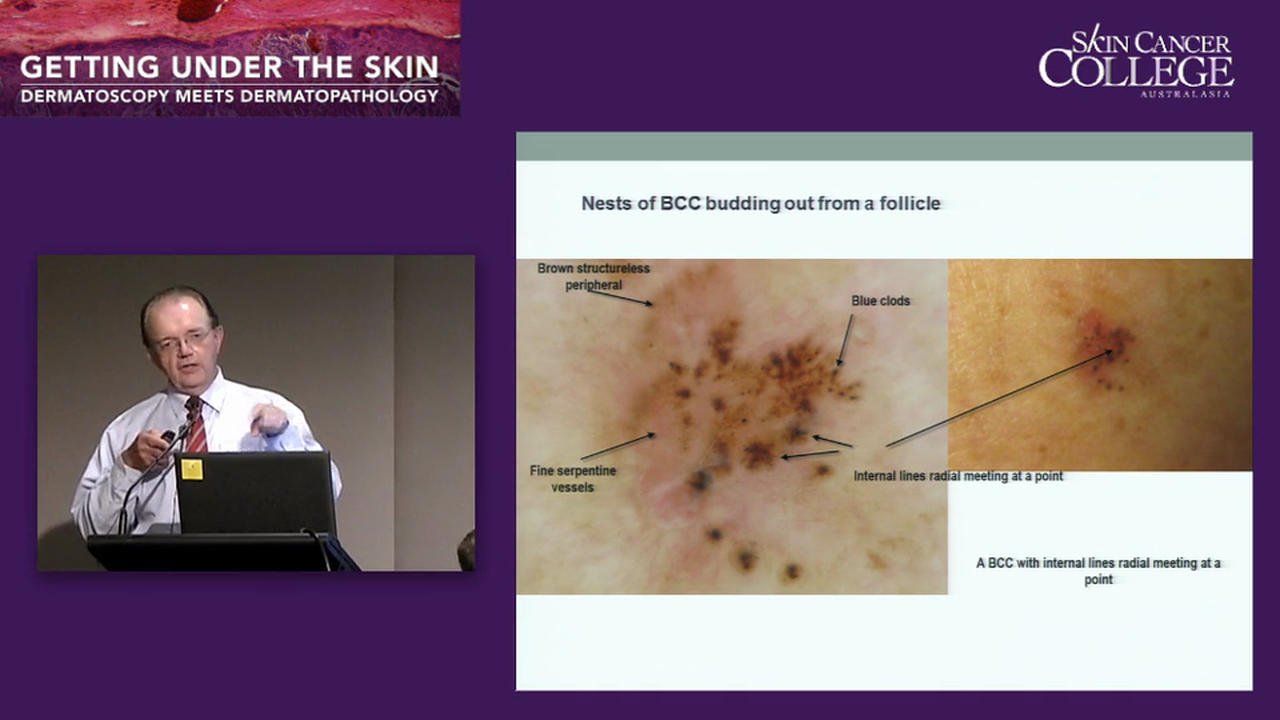 Basal and Squamous cell carcinomas Dr Clay Cockerell Dr Ian McColl