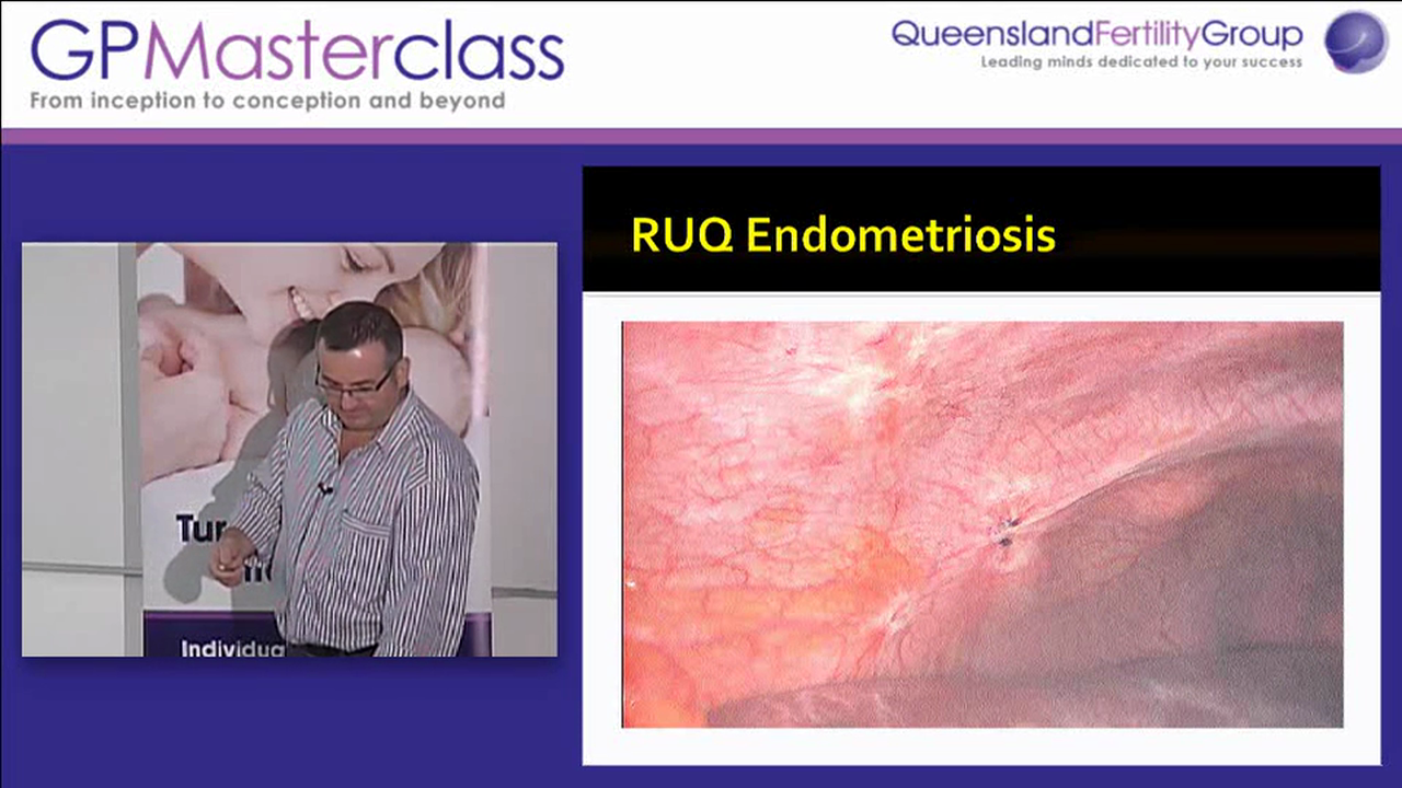 Update in surgical gynaecology Dr Gary Swift