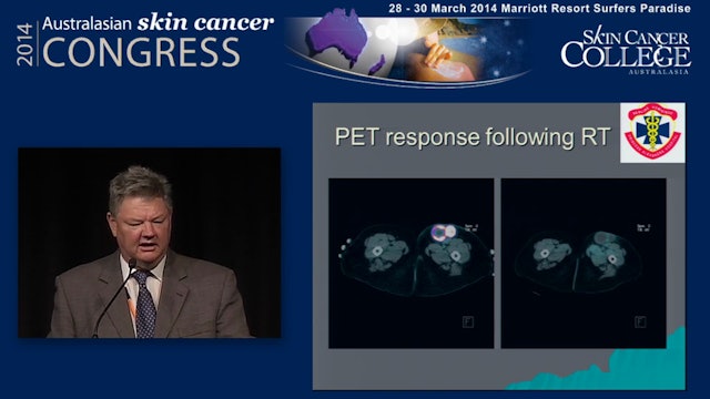 Radiotherapy and melanoma Dr Bryan Burmeister