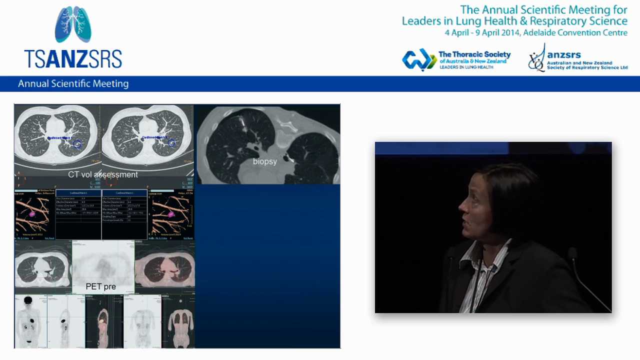 Thermal ablation of lung cancer Karin Steinke