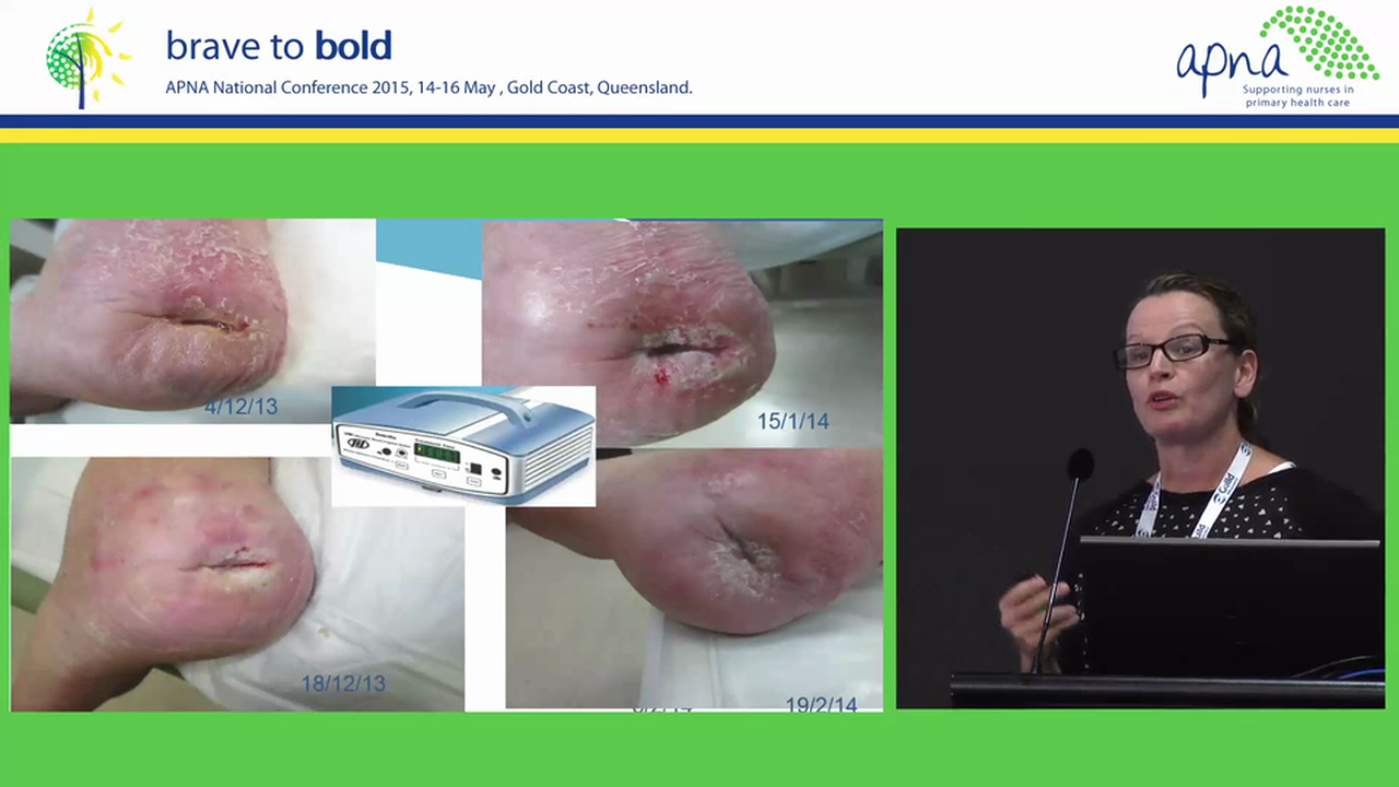 Wound Care Speaker Karen Innes-Walker, Patrice Cafferky, Nicola Morley and Alison Oakes