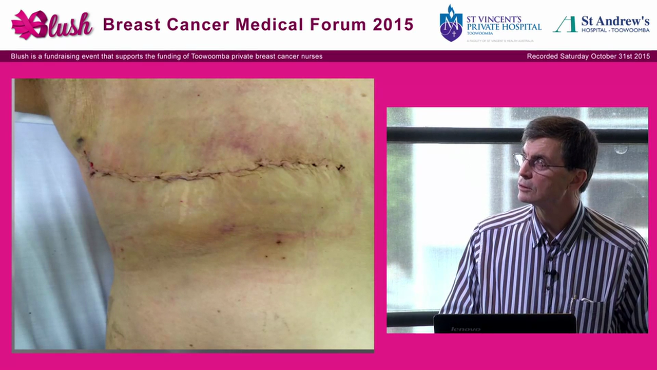 Mastectomy - Tim Porter