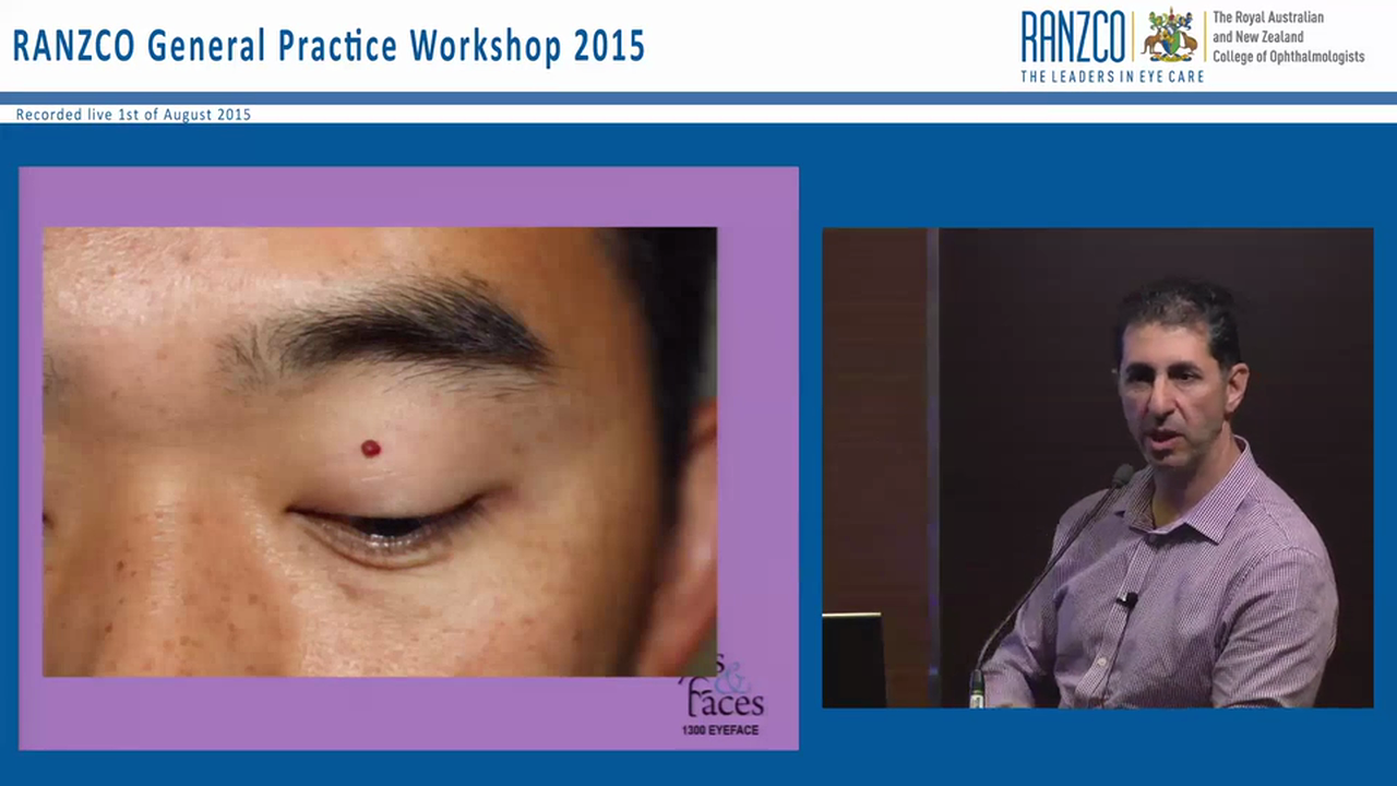 Lumps and bumps around the eye - Dr Anthony Maloof