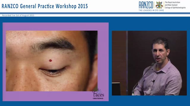 Lumps and bumps around the eye - Dr A...