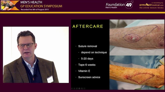 Skin Cancers - Understanding the Principles of Surgical Excision and Different Reconstructive Options Nick Houseman Plastic and Reconstructive Surgeon