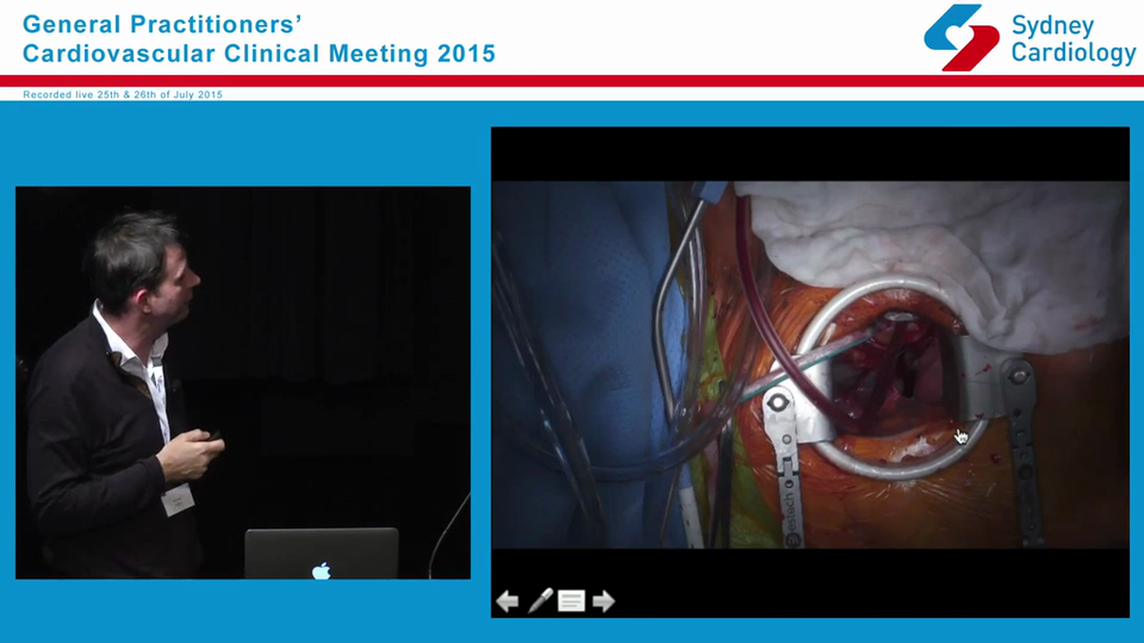 Minimising the invasiveness of heart surgery Prof. Michael Vallely MBBS, PhD, FRACS Cardiothoracic Surgeon - Macquarie University Hospital & RPA