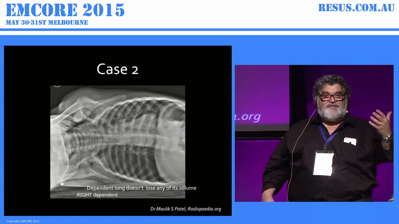 The choking child AProf Peter Kas Emergency Physician. Founder of resus.com.au and creator of EMCORE. Clinician at Monash Health and AProf at University of Notre Dame