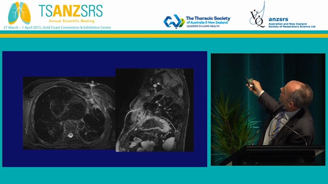 Radiology of pleural disease - what clinicians need to know Fergus Gleeson Oxford University Hospitals NHS Trust, United Kingdom