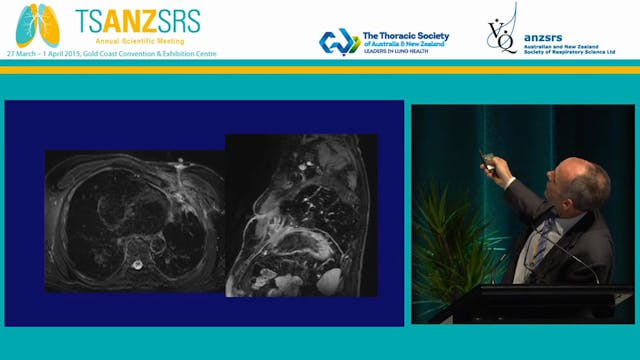 Radiology of pleural disease - what c...