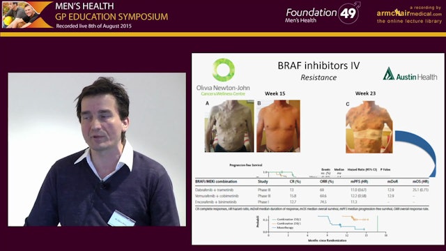 Treatment of Metastatic Melanoma -  Moving Towards Targeted Therapy and Modern Immunotherapy Dr Oliver Klein Oncologist