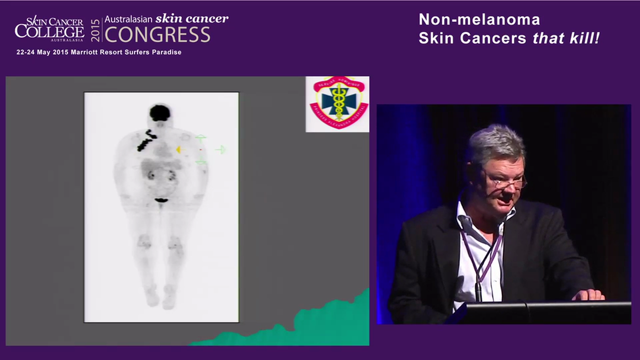 2A.2 Radiotherapy for non-melanomatous skin cancer (NMSC) – Professor Bryan Burmeister