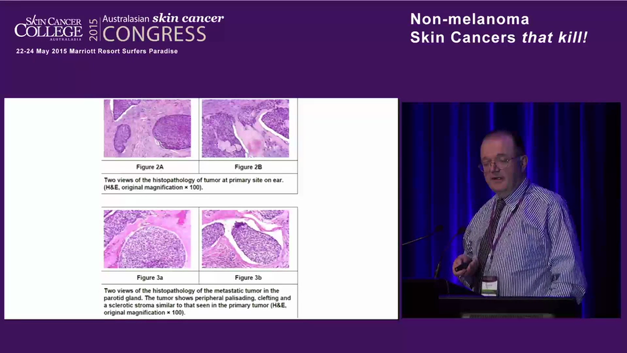 Cutaneous metastases – Dr Ian McColl