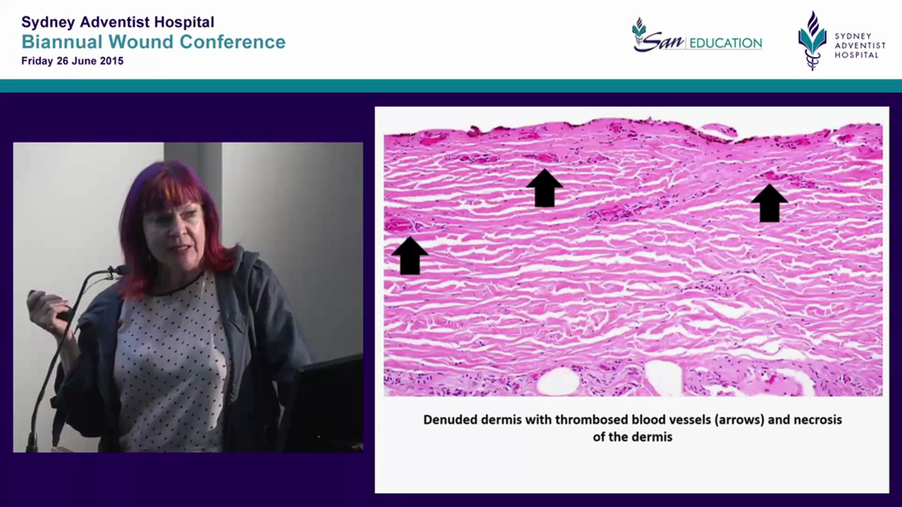 To cover or pop  managing the blister Rae Johnson