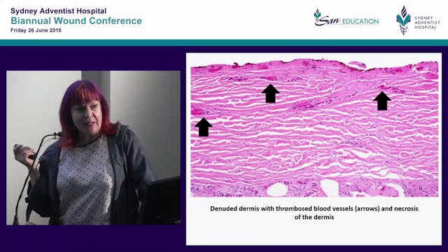 To cover or pop  managing the blister...