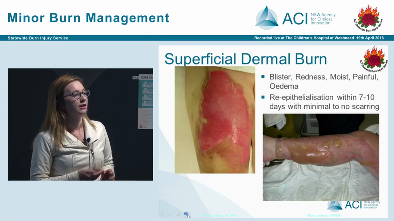 Burns assessment and overview Tracy Hurley