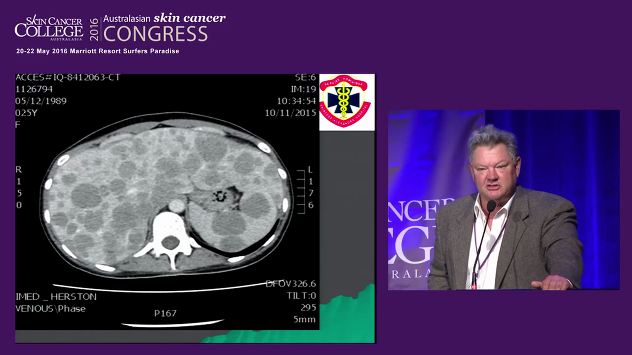 A personalised approach for treating melanoma with radiotherapy Prof Bryan Burmeister