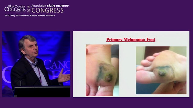 Management of melanoma in unusual positions Prof Mark Smithers