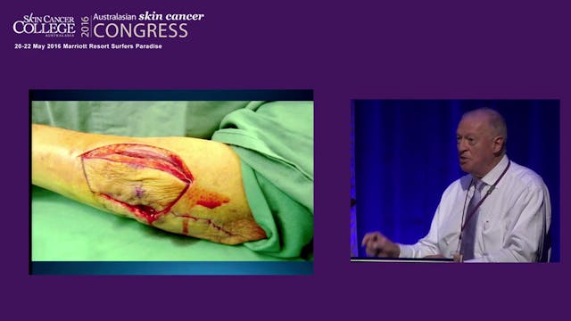 Melamoma trends, treatments and techn...