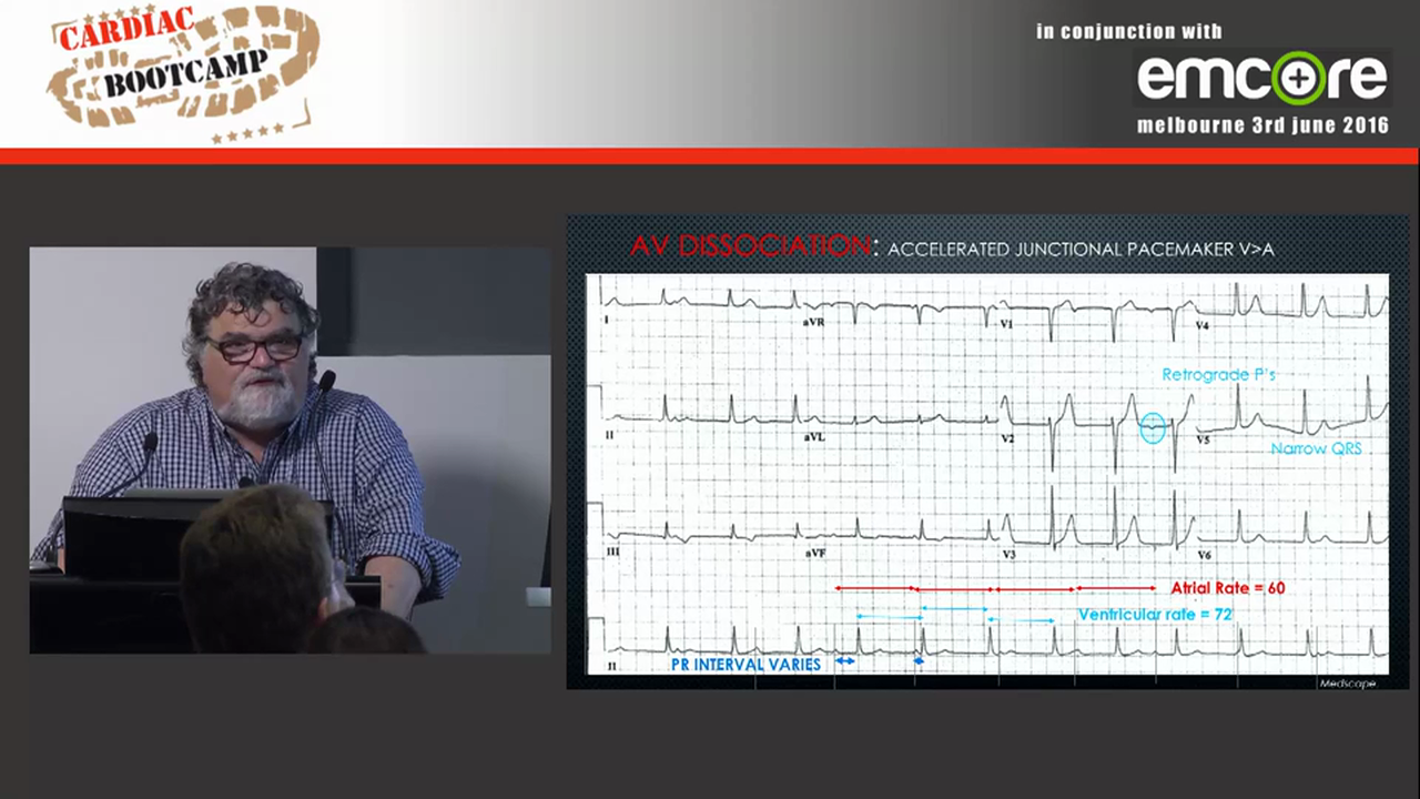ECG in 20 secs Rate rhythm P-QRS relationship Assoc Prof Peter Kas