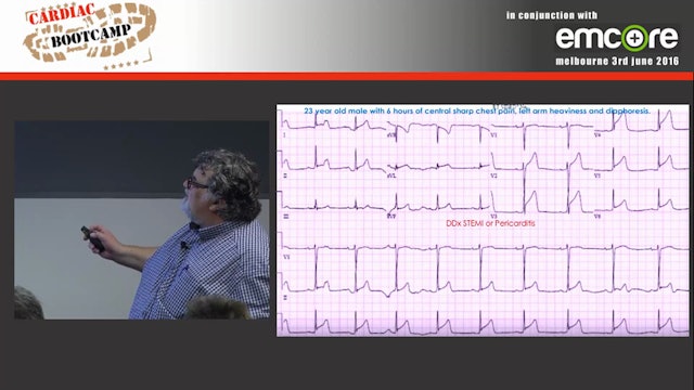 ECG in 20 secs QRS Complex A Prof Peter Kas