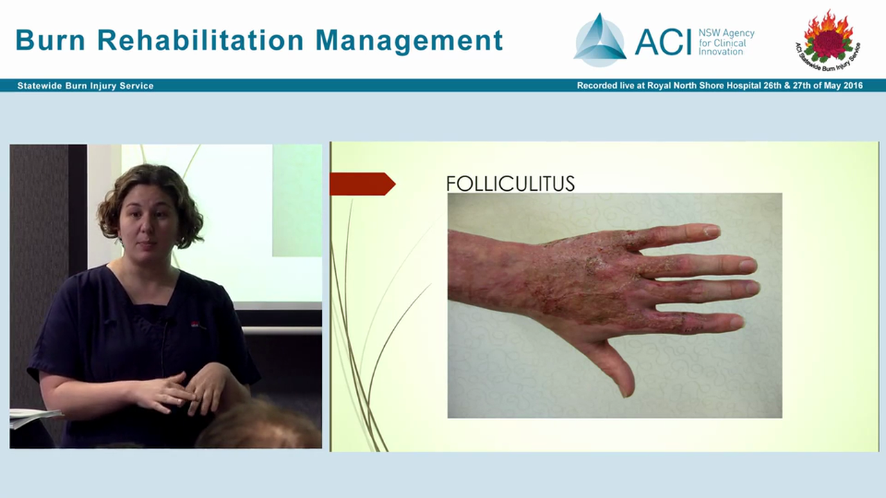 Burn Wound Management in Rehabilitation setting Kate Welsh