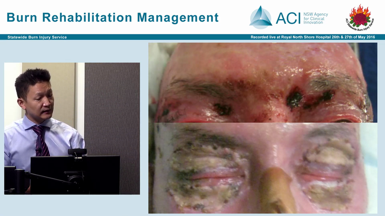 Burns Reconstruction Surgery Dr Jeon Cha