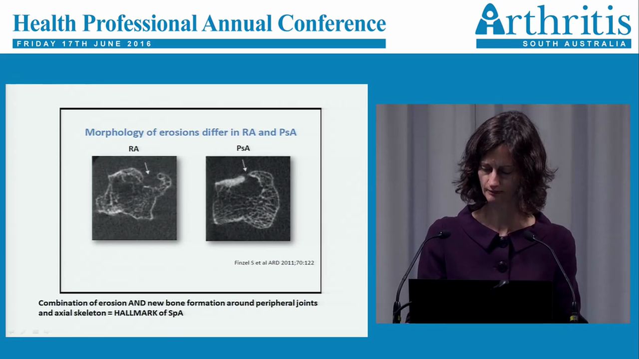 Psoriatic Arthritis Dr Eliza Pontifex