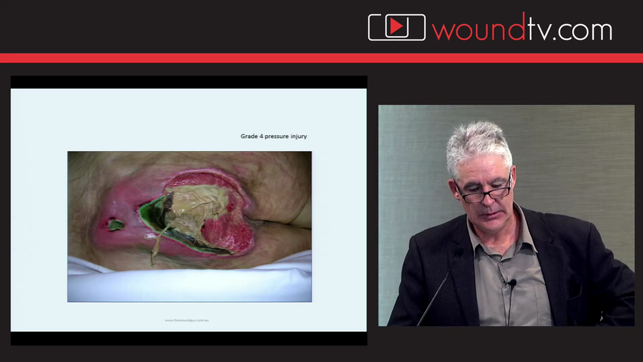Negative Pressure Wound Therapy Gary Bain