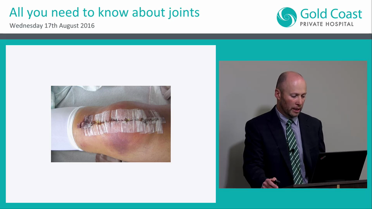 Rapid Recovery & Rehab Improving outcomes in joint replacement Dr Price Gallie Gold Coast