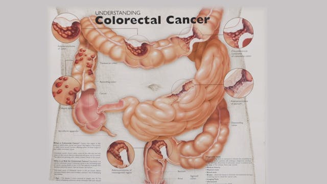 Colonoscopy & Colorectal Cancer with Dr. Krishna