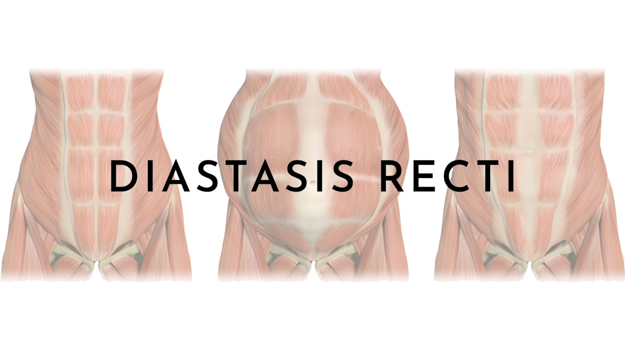 What is Diastasis Recti?