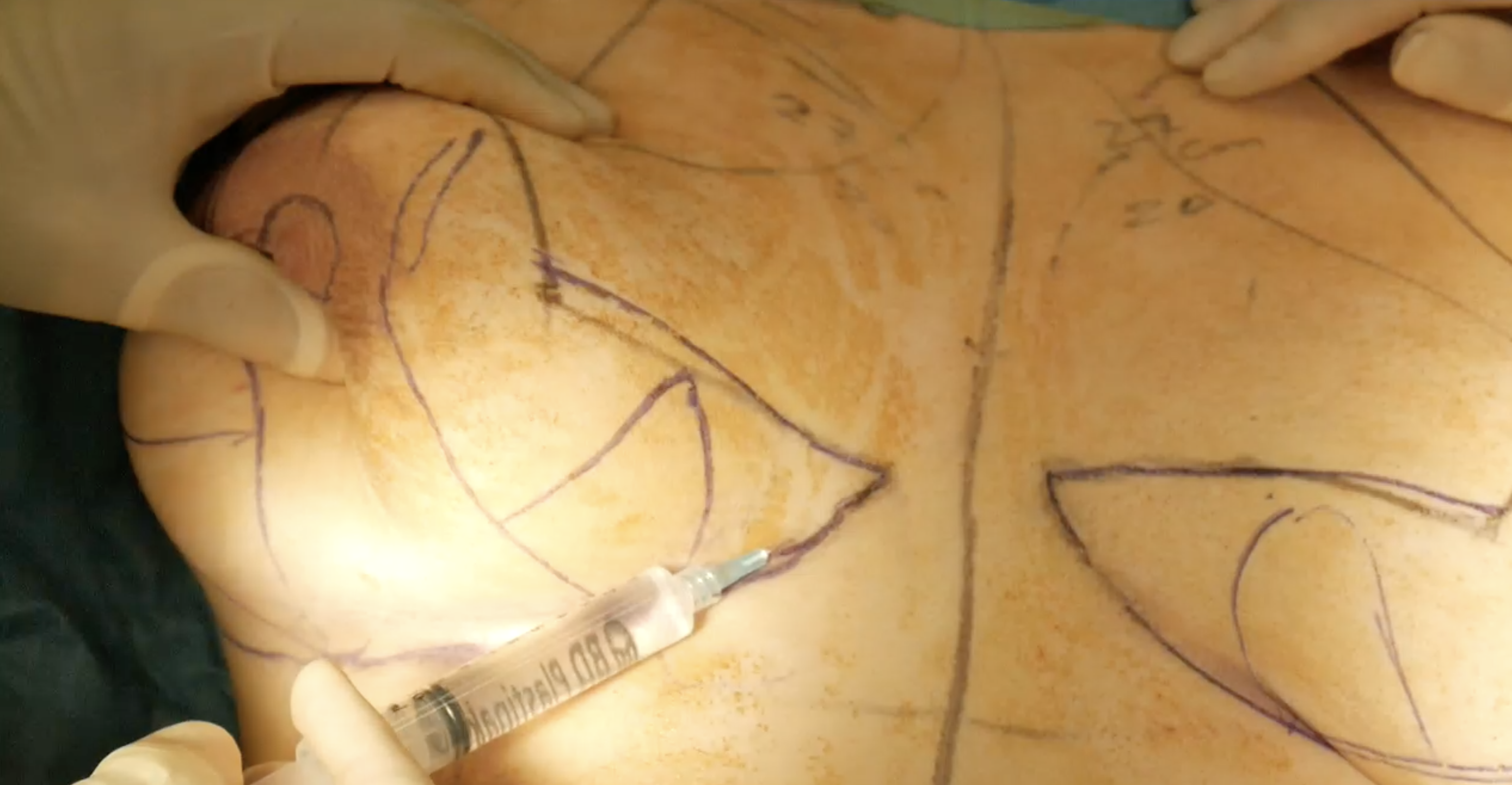 'Dermal Wings' Technique for Breast Reduction & Mastopexy : surgery