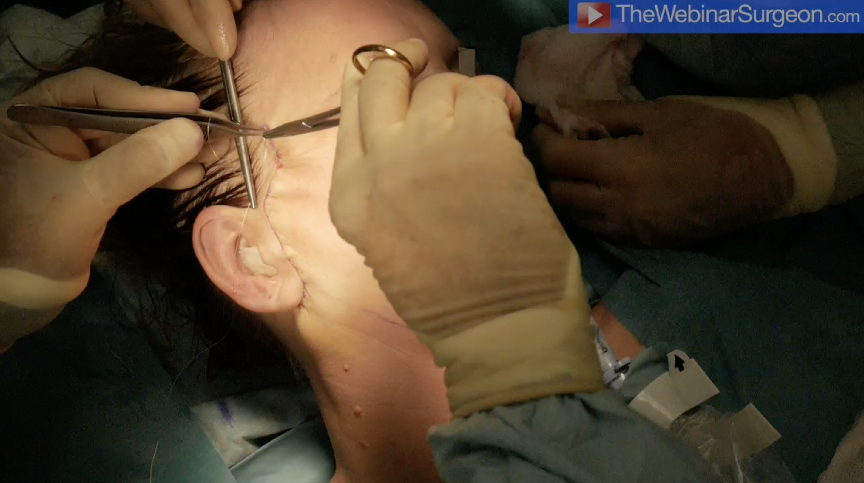 ‘R’ Face and Neck Lift 1 - Surgery