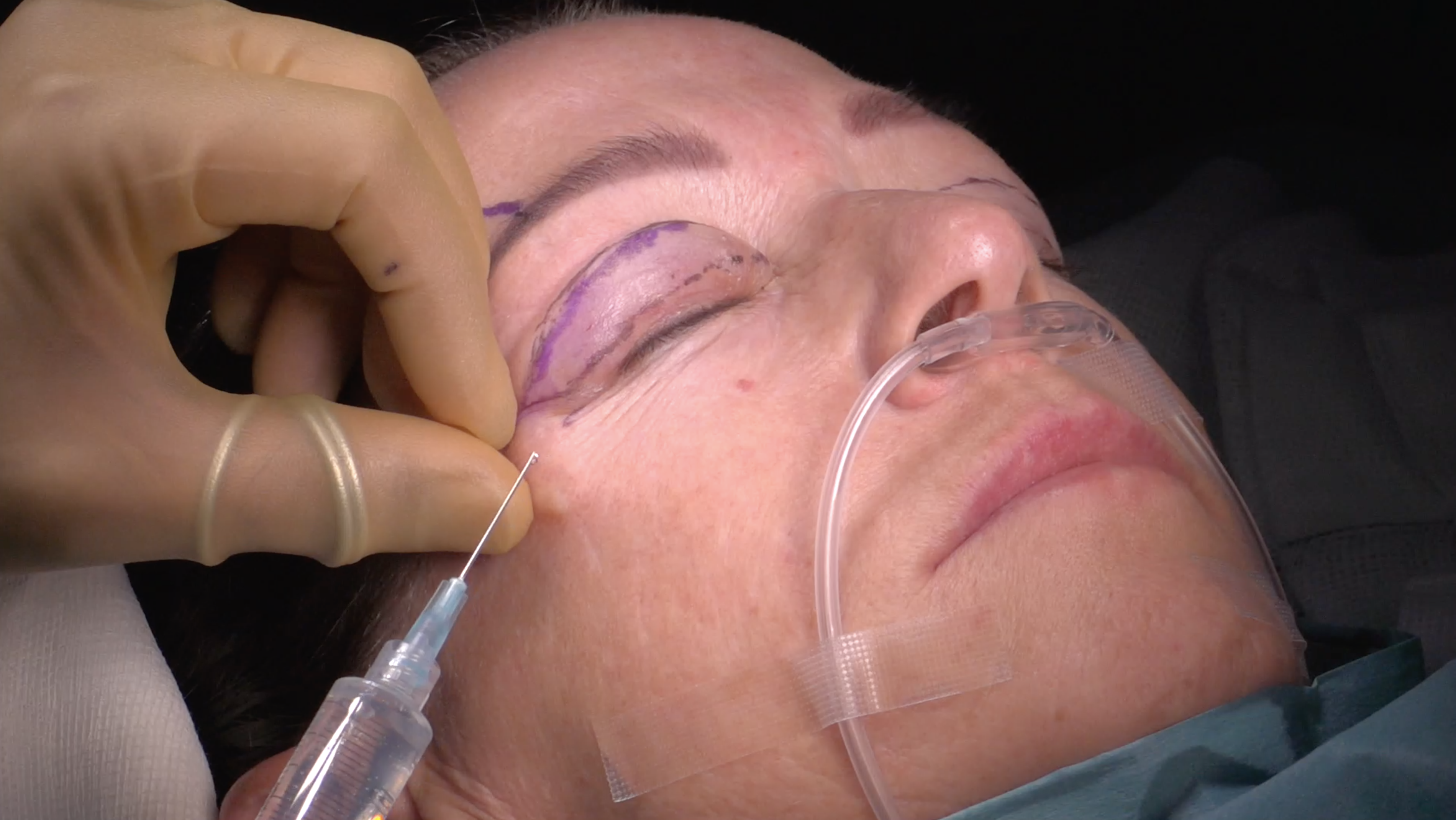 Lower Blepharoplasty