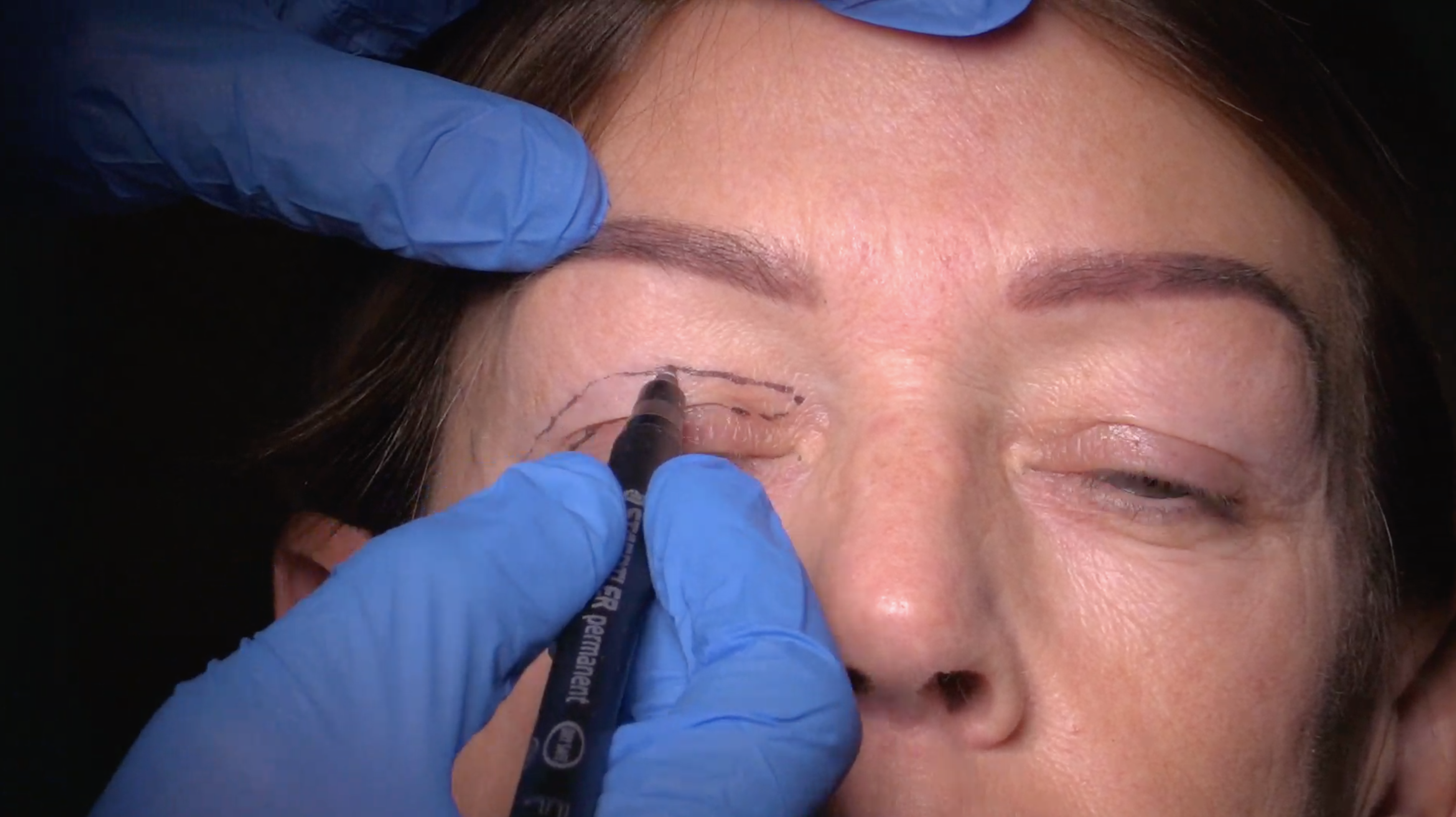 Upper Blepharoplasty
