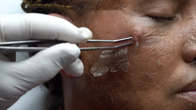 Chemical Peel 1 Week Post op