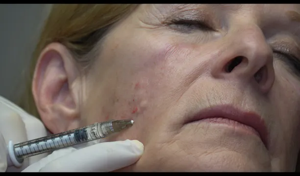 Cheek FIller with Cannula