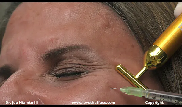 90 Units of Dysport to Glabella and Lateral Canthus