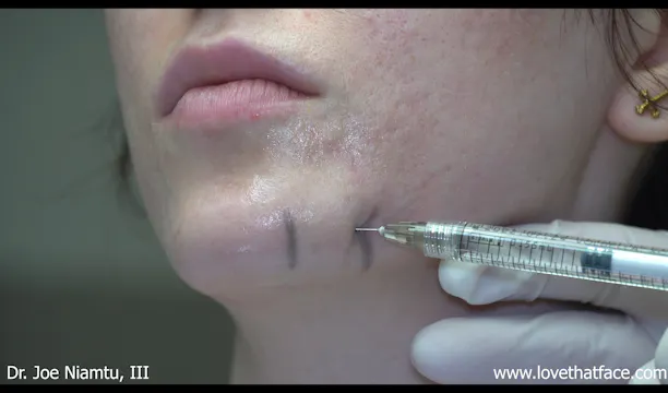 Filler to Mandibular Border