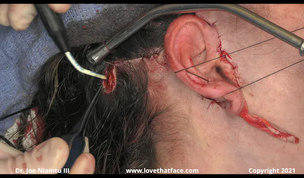 Unilateral Facelift with CO2 Part 3