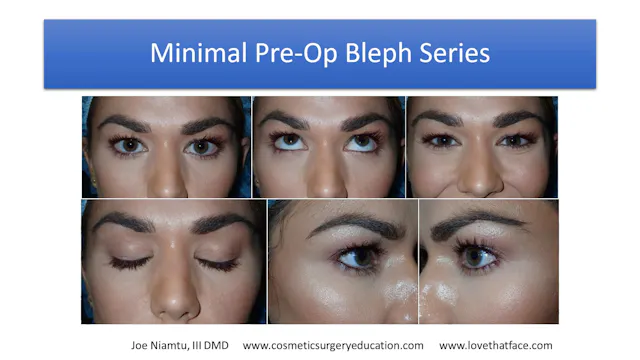 Platinum Blepharoplasty Lecture