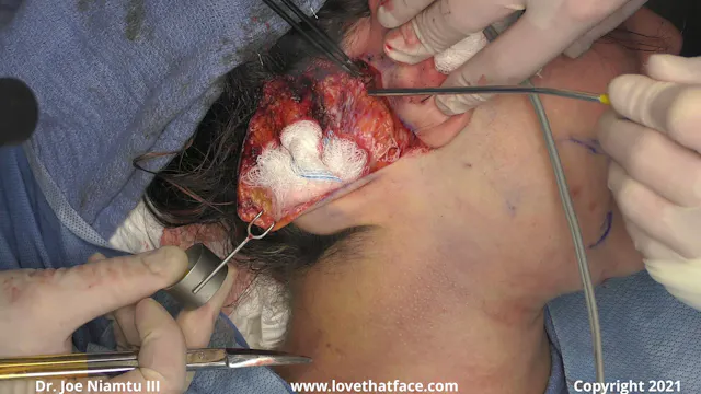 Case 2 Part 1. Unilateral Nonstop Facelift with Full Face CO2 Laser Resurfacing